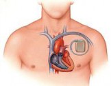 Имплантация электрокардиостимулятора